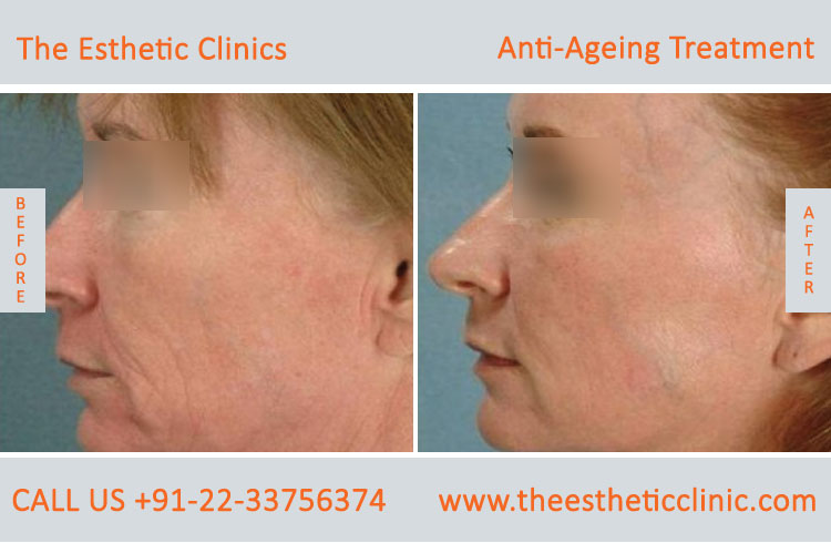 Anti Aging Treatment for Face Wrinkles before after photos in mumbai india (1
